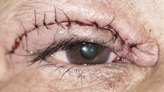 Augenlid-Straffung bei Männern – Besser sehen, besser aussehen?