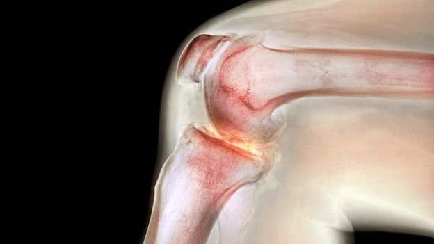 Knie-Arthrose – Was hilft wirklich?
