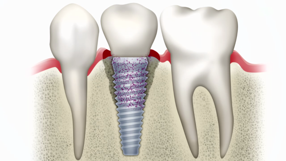 Zahnimplantate – Heikler als man meint