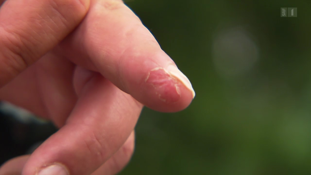 Wie krank abgeschnitten fingerkuppe lange Fingerkuppel angeschnitten