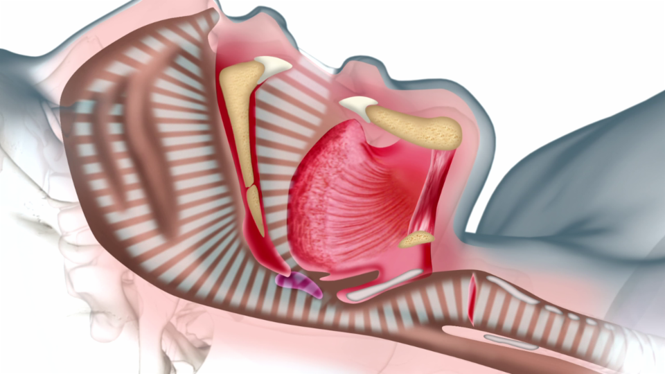 Typische anatomische Schnarchauslöser: Schlaffes Gaumensegel, ansinkender Zungengrund, runterklappender Kehldeckel, zu grosse Gaumenmandeln.
